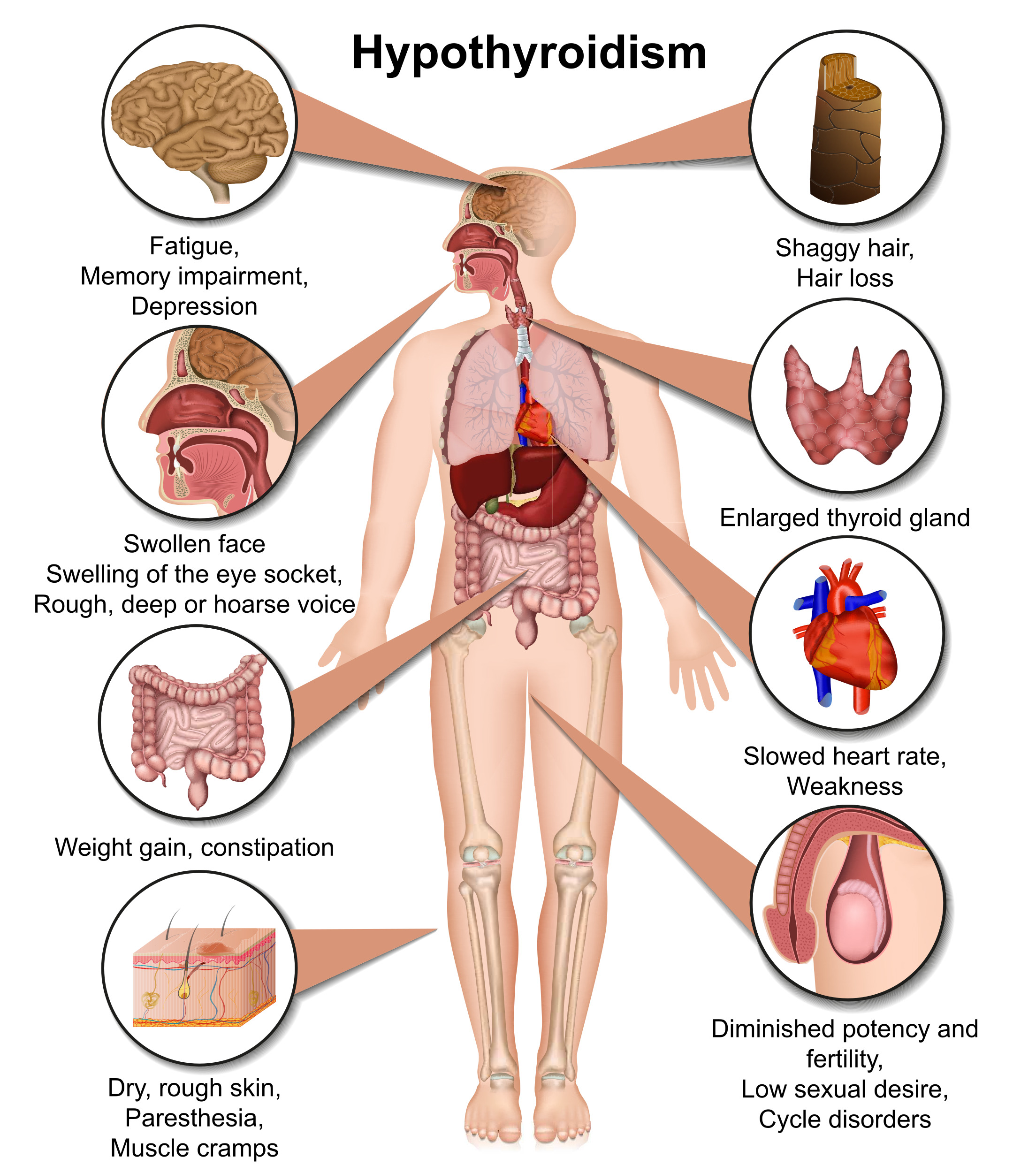 Симптомы гипотиреоза