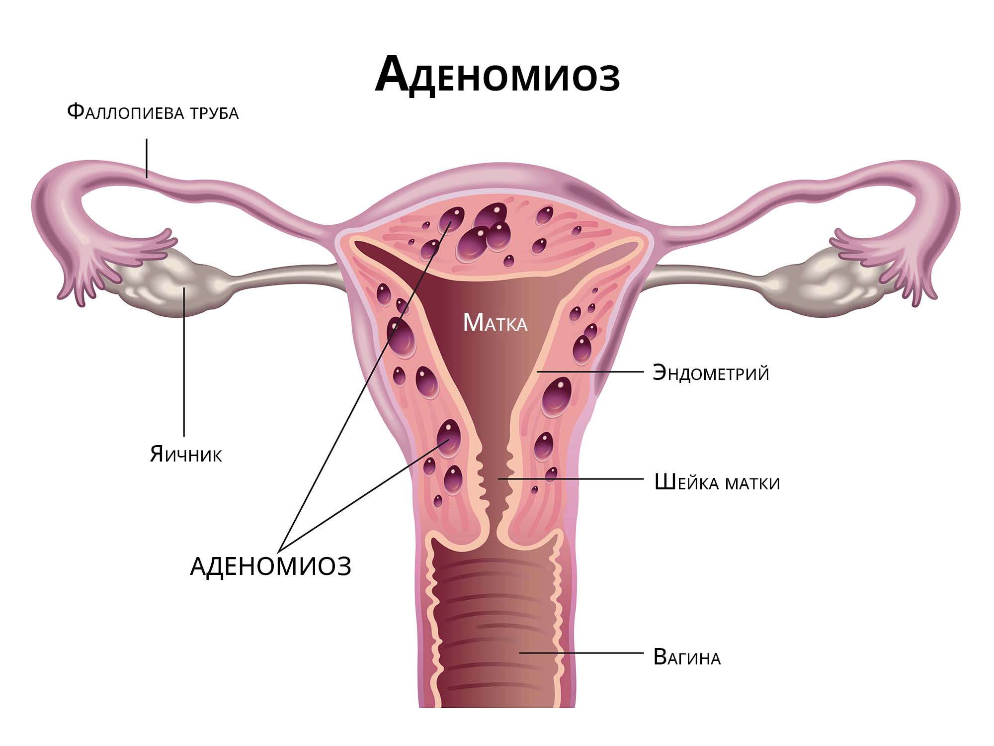 Аденомиоз