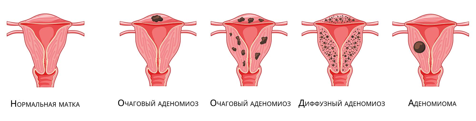 Аденомиоз