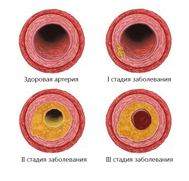 Атеросклероз сосудов сетчатки