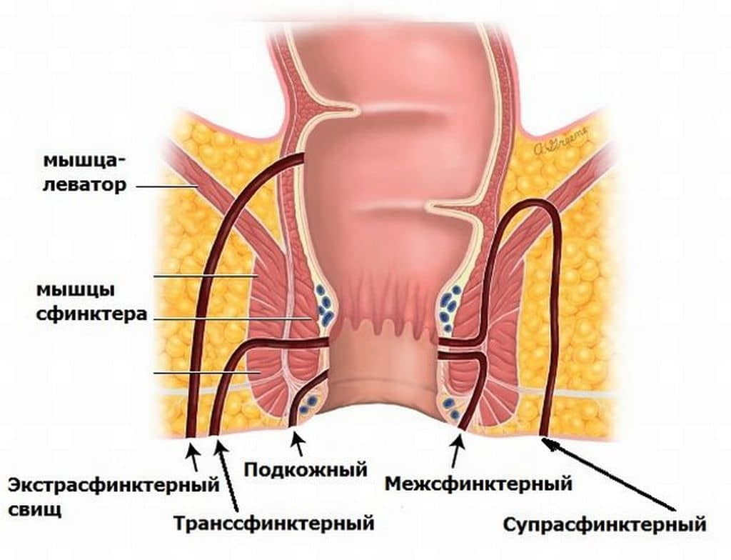 Свищ прямой кишки (хронический парапроктит)