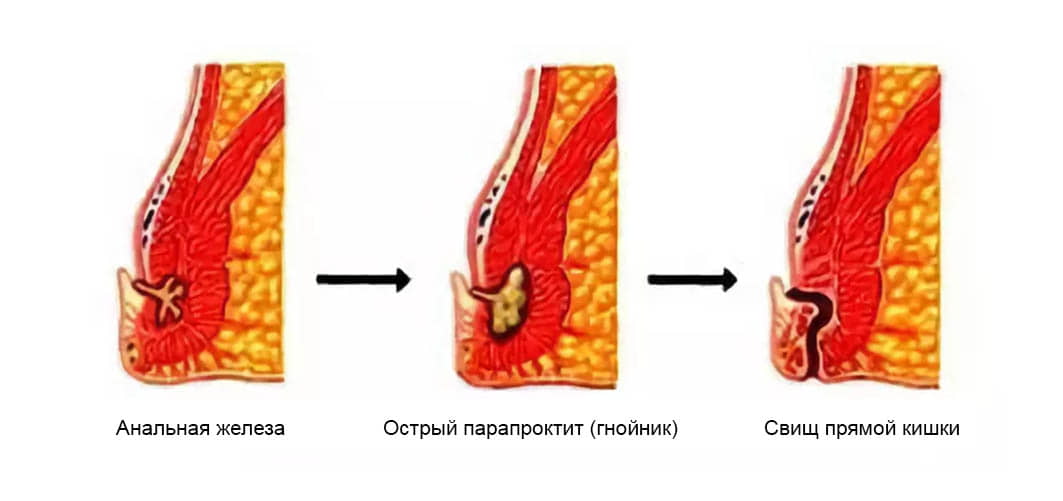 Парапроктит операция
