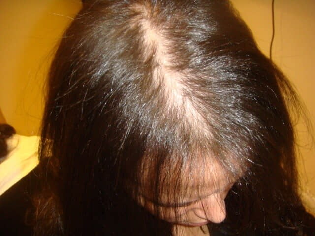 Выпадение волос у мужчин лечение спб thumbnail