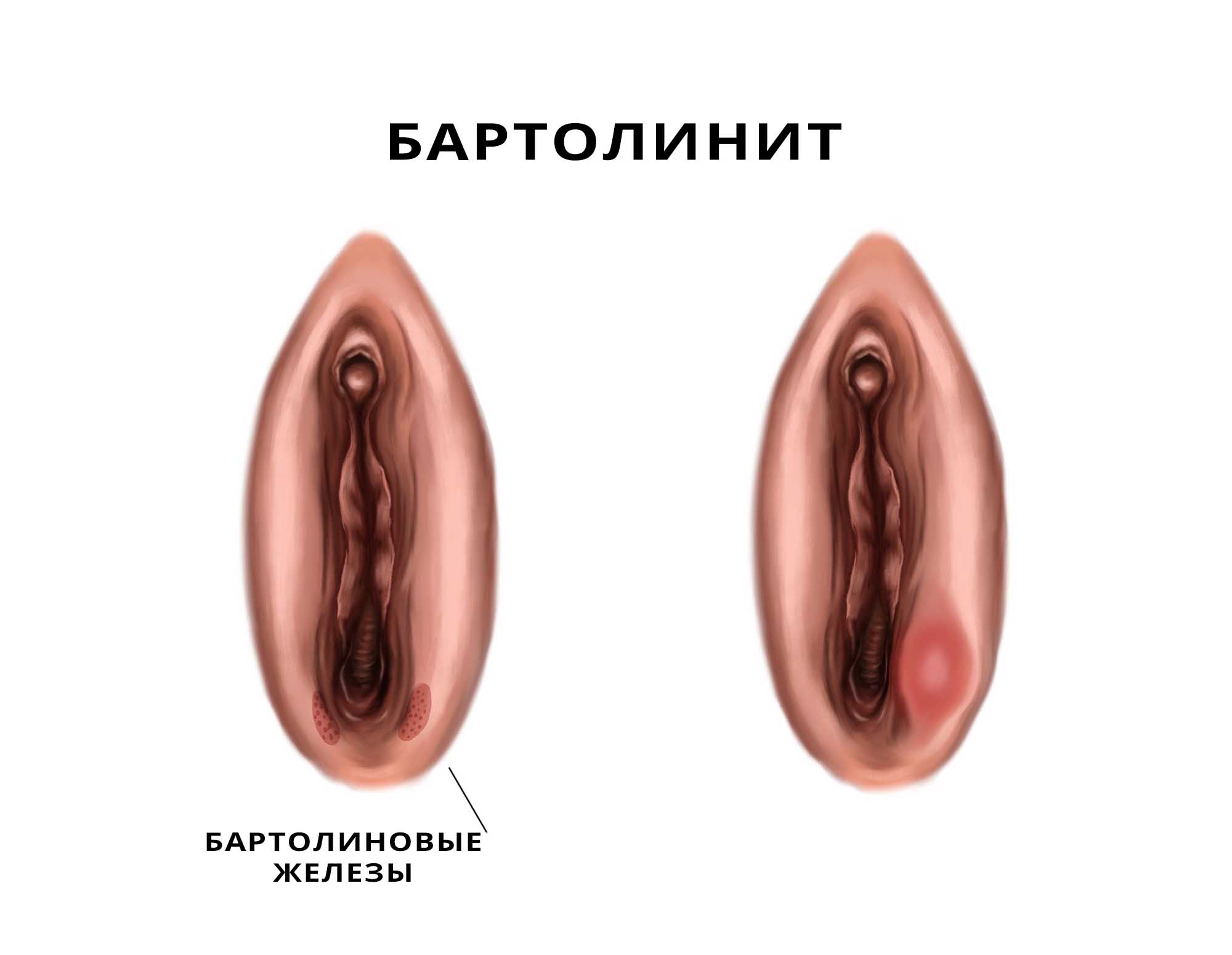 Патогенез