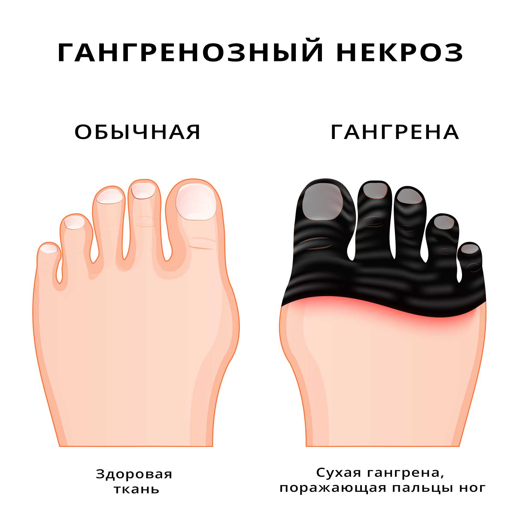 Сухая гангрена