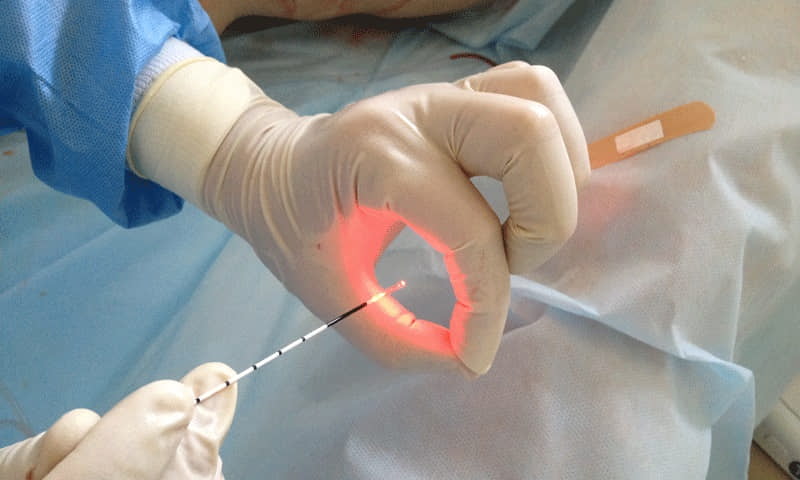 Лазерное лечение простатита