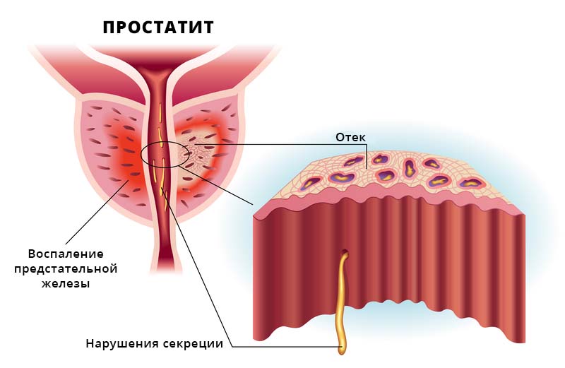 Заболевание предстательной железы