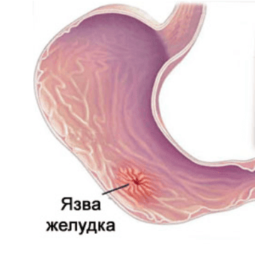 Где лечат язву желудка в спб