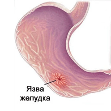 Как Выглядит Язва Фото