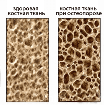 Остеопороз – коварное заболевание