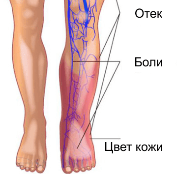 Может болеть нога от вен