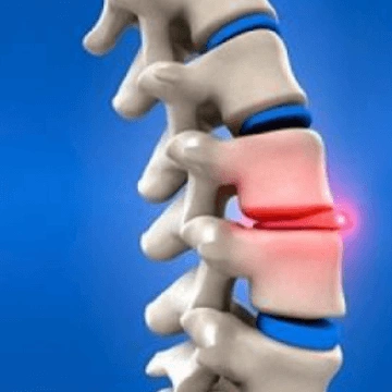 Грыжа Шморля диагностика профилактика лечение - полезная информация на ЛечениеГрыжирф