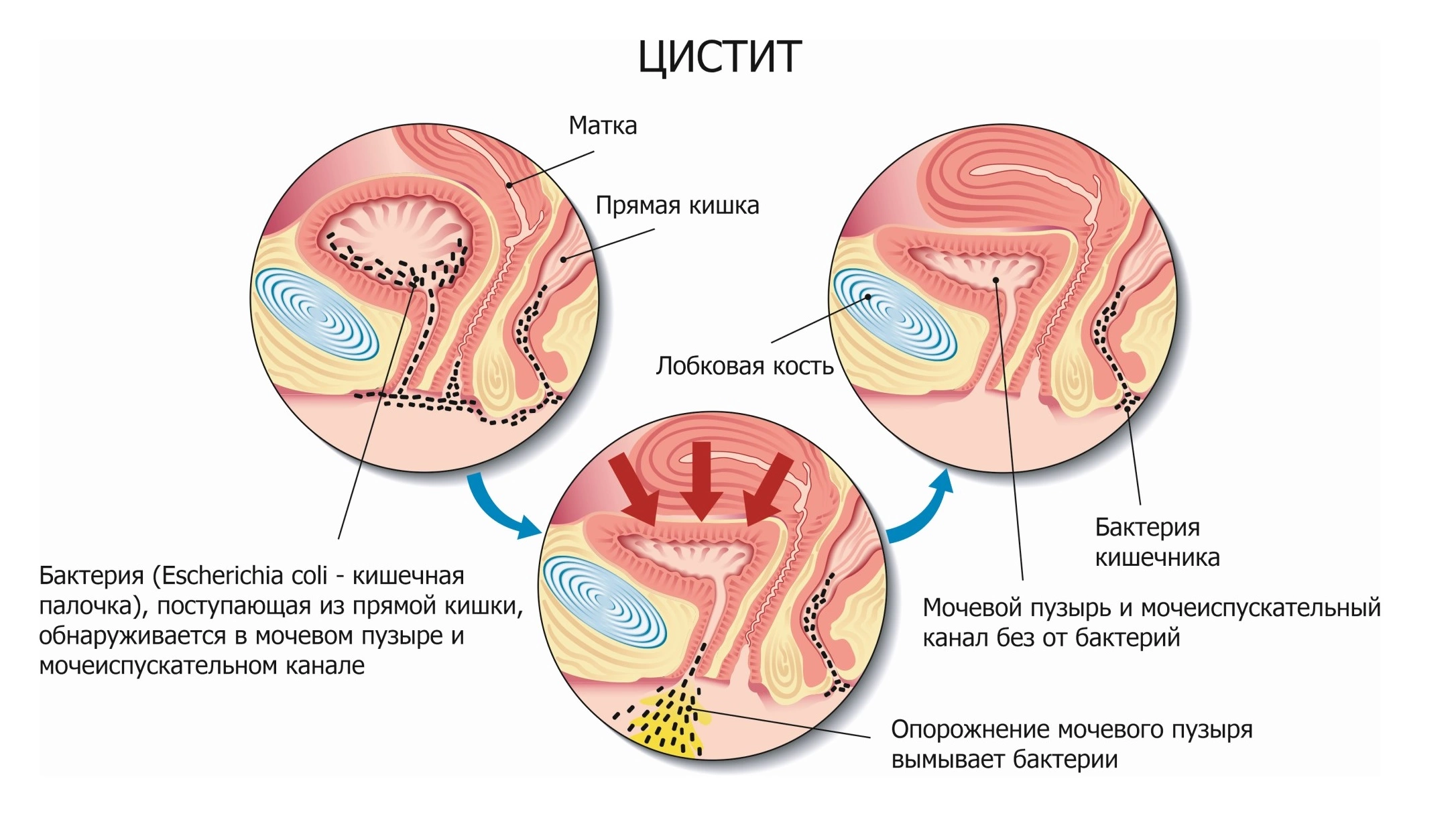 Причины цистита у мужчин