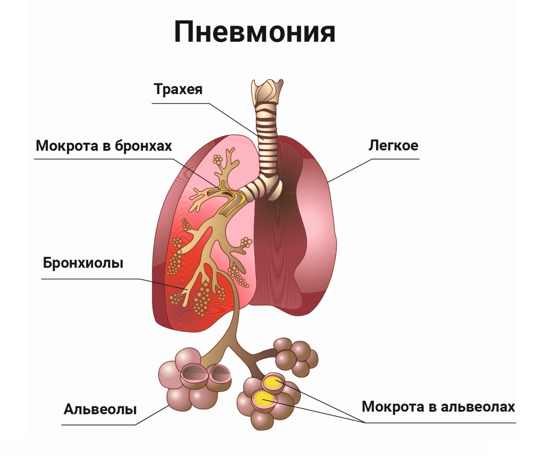 Пневмония