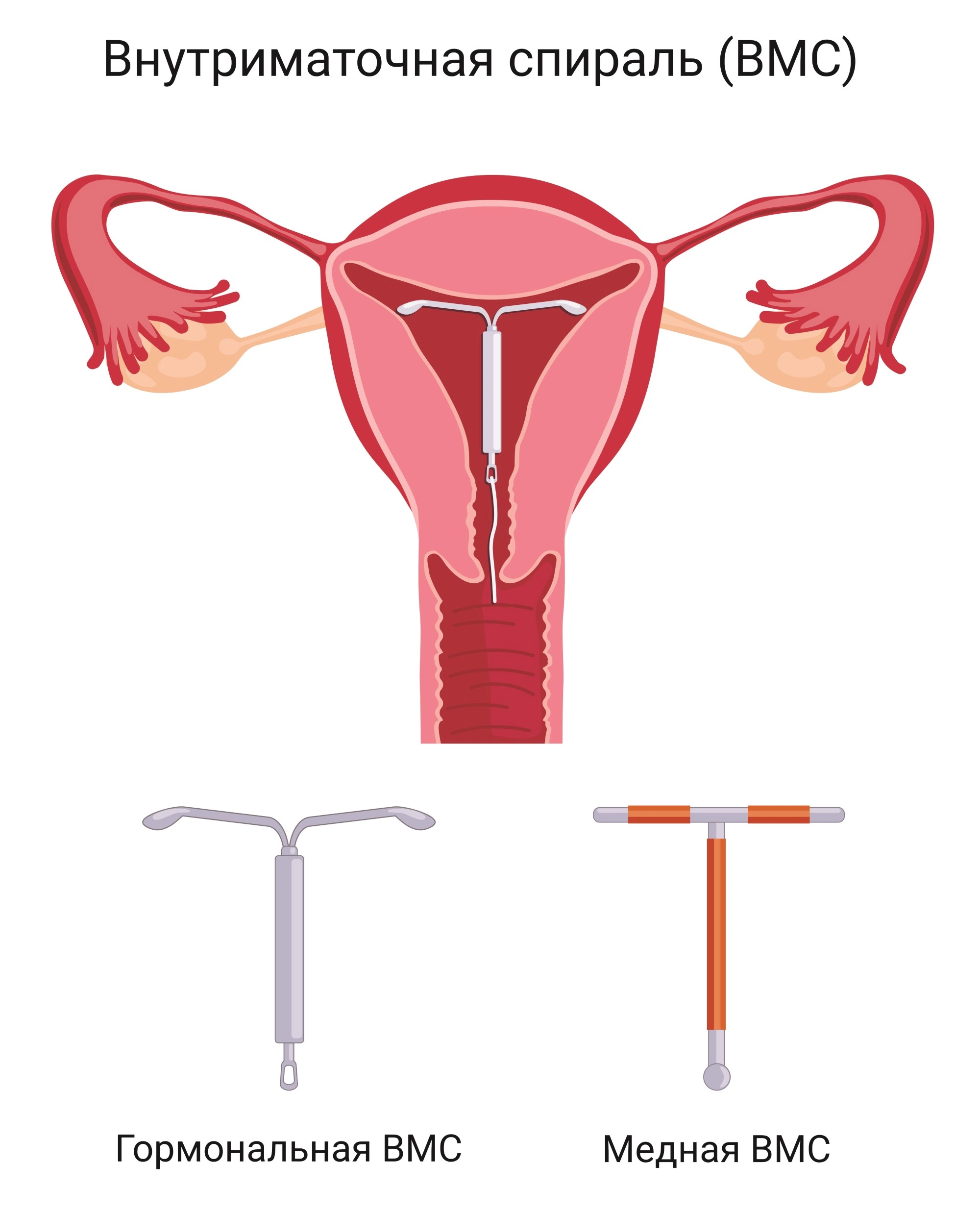 Снять спираль ВМС - удаление внутриматочной спирали мирена в Москве