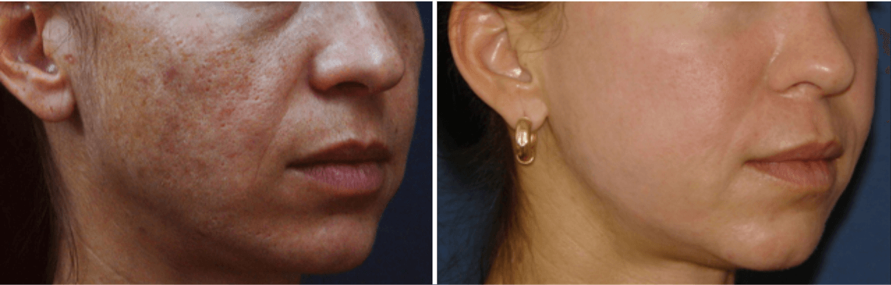 Плазмолифтинг для лица до и после фото. Плазмолифтинг лица до и после. Плазменная шлифовка кожи. До и после плазмолифтинга лица. Плазма крови в лицо