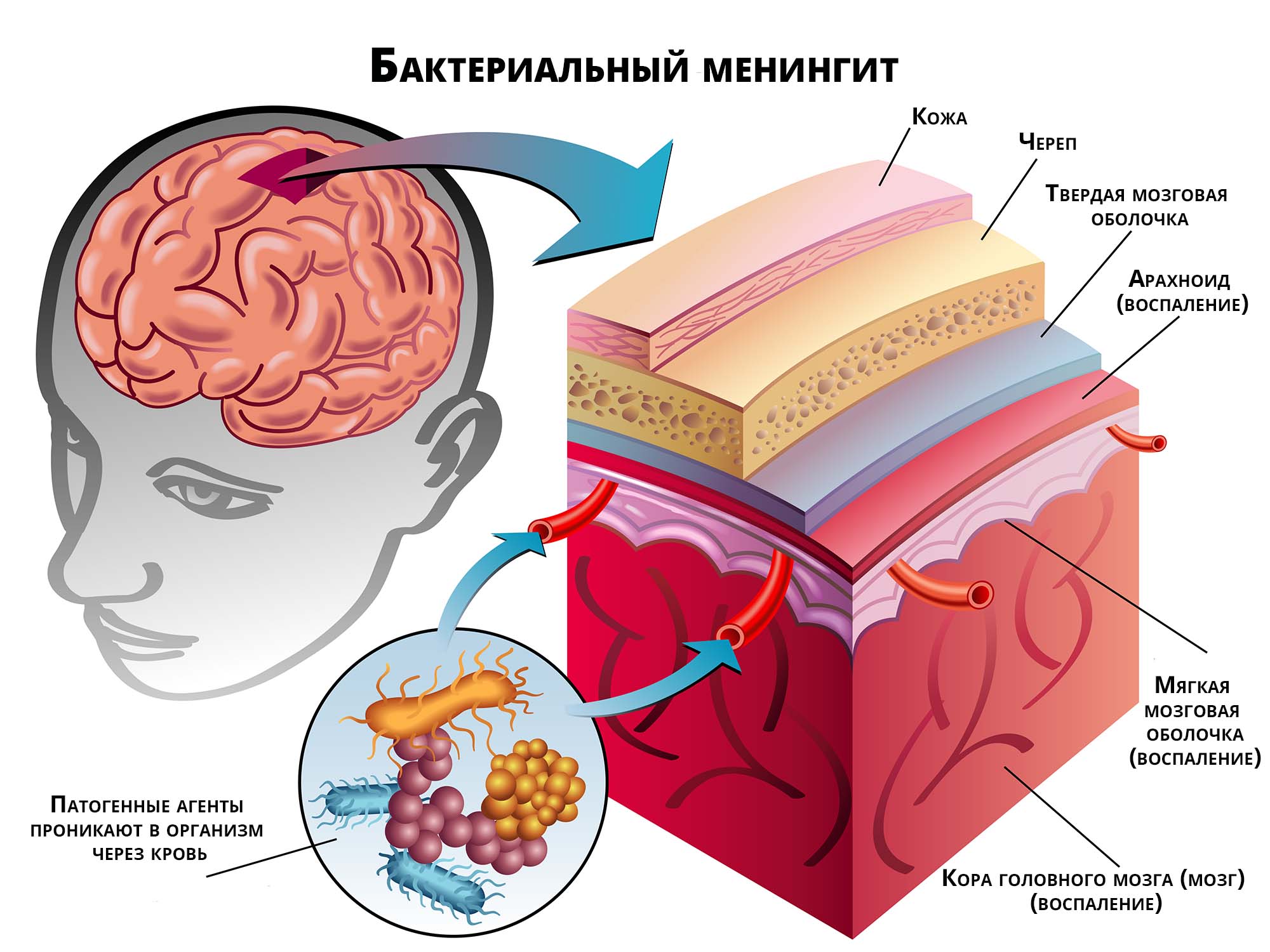 Бактериальный менингит