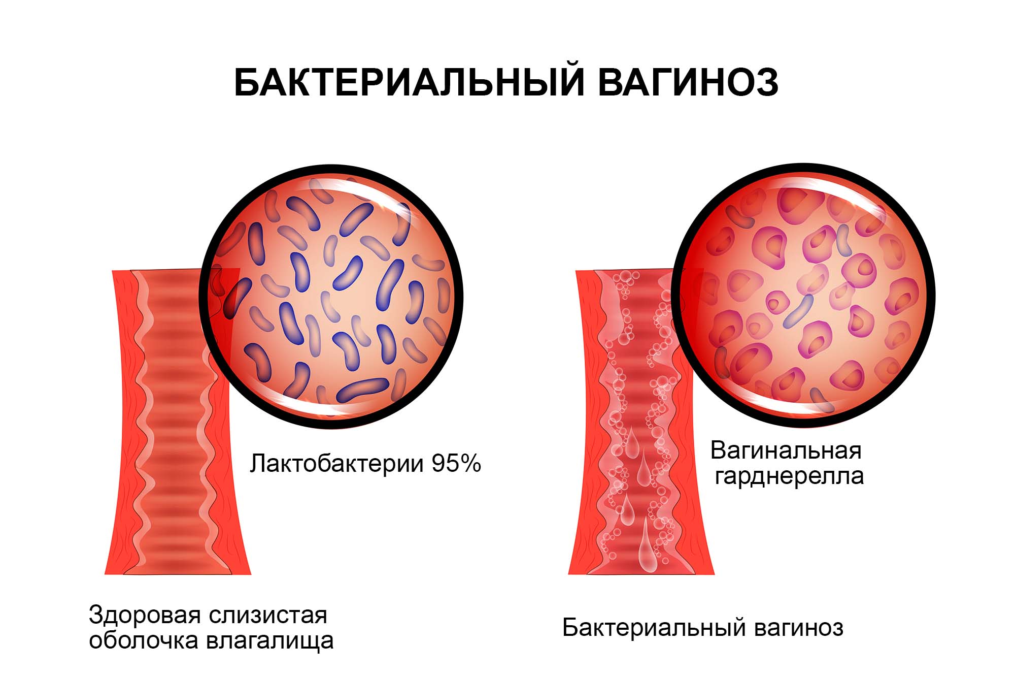 Бактериальный вагиноз