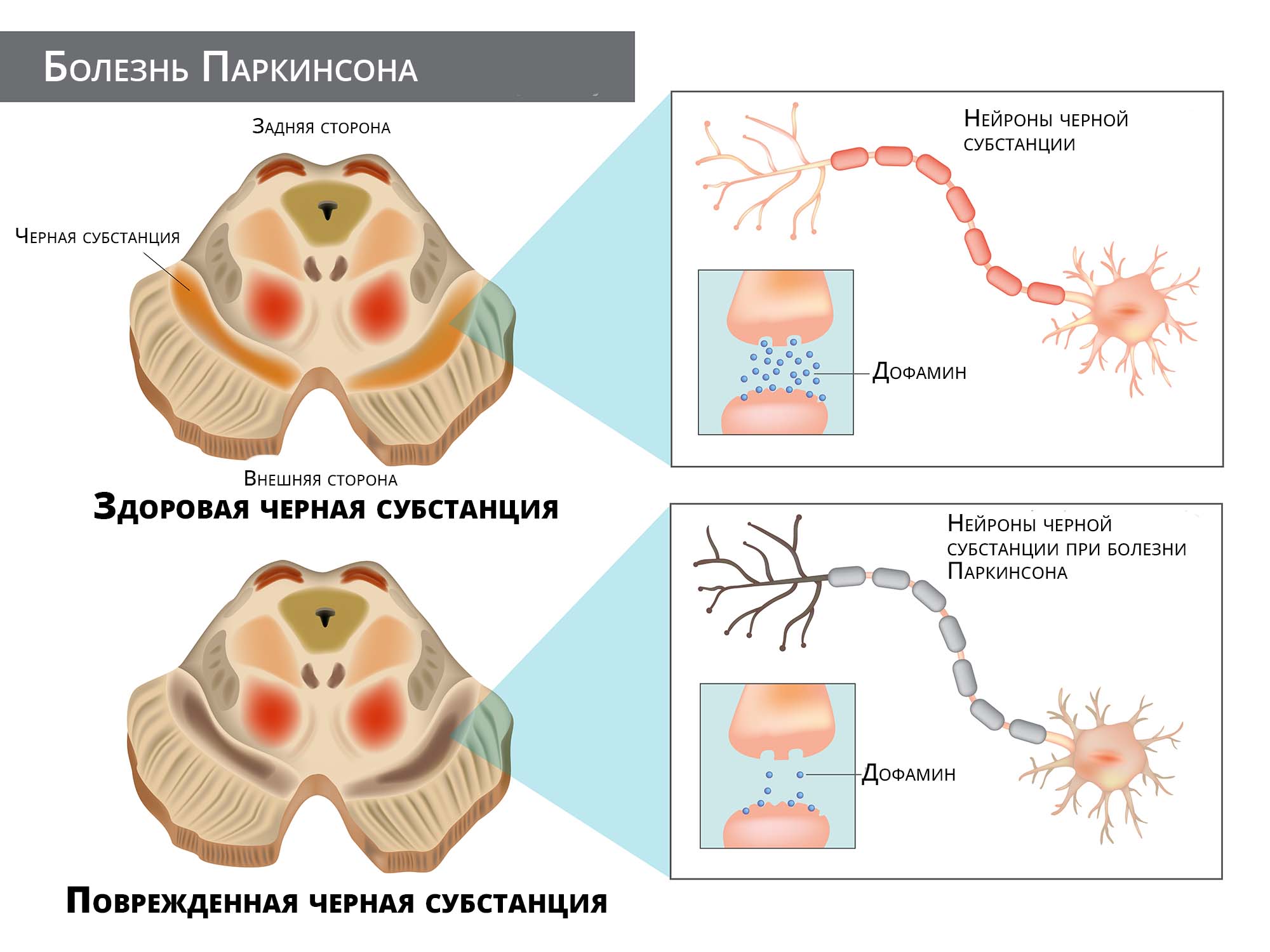 Болезнь Паркинсона