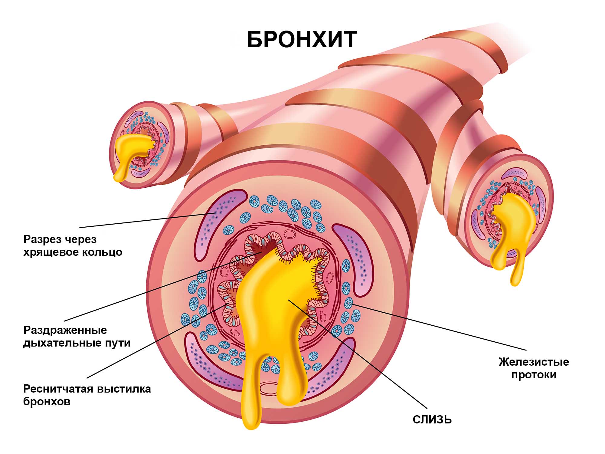 Бронхит