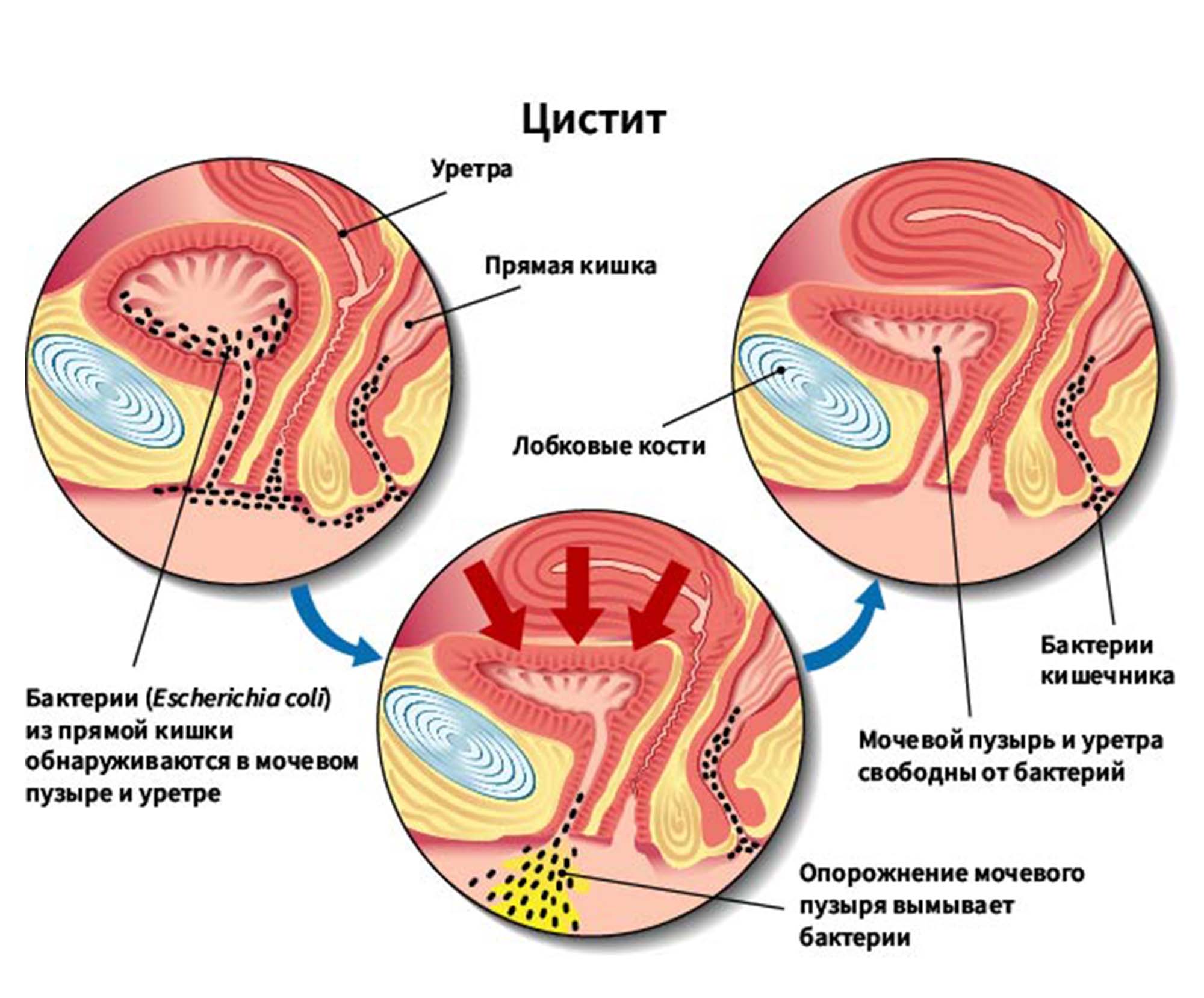 Цистит у женщин