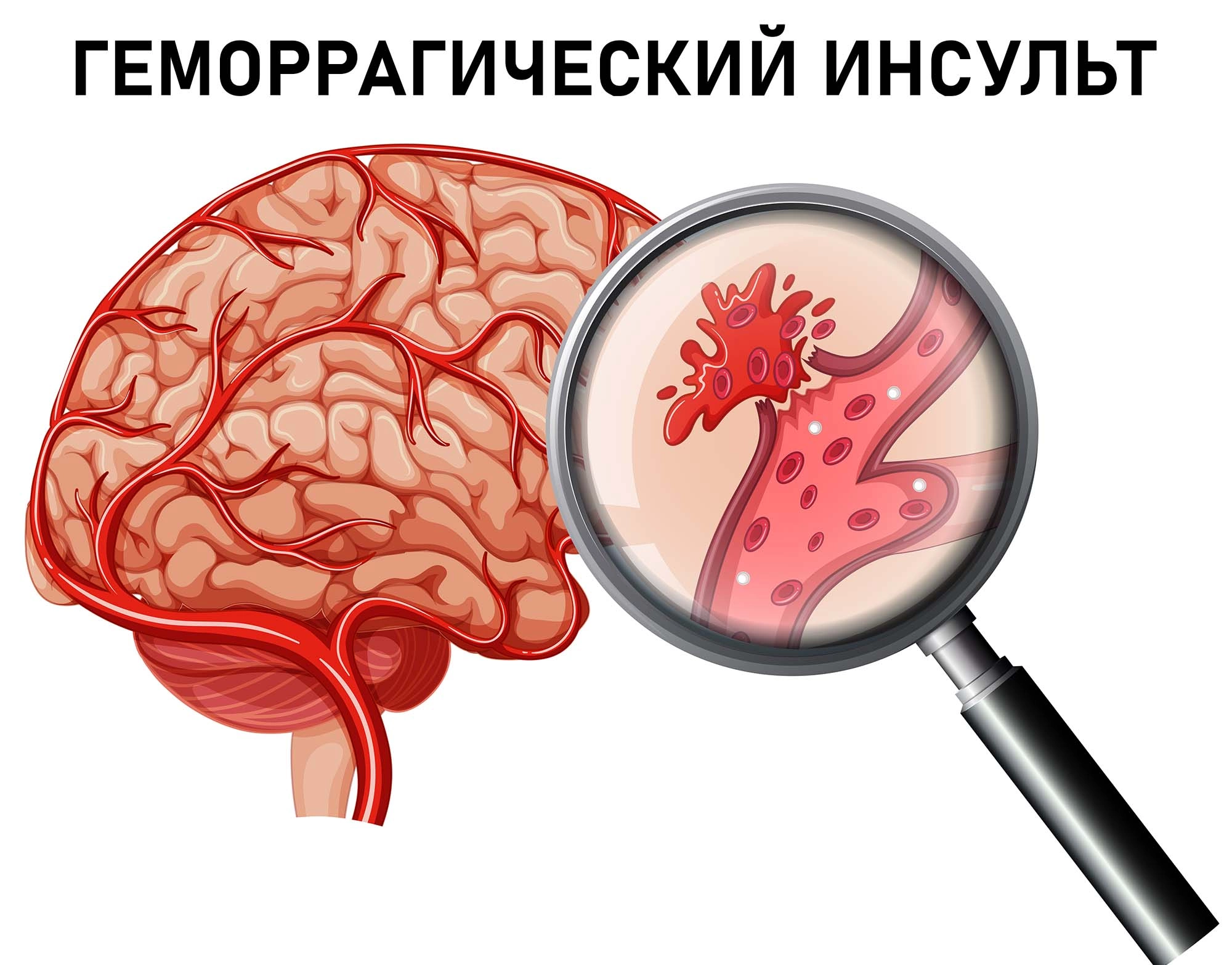 Геморрагический инсульт: причины, симптомы, признаки, прогноз, лечение