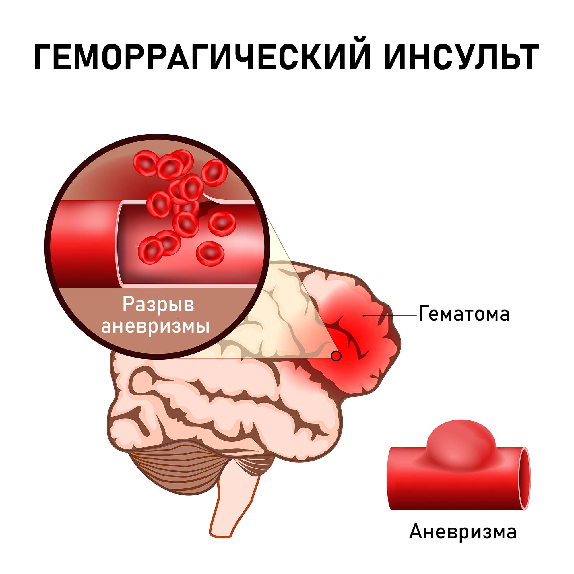 Инсульт геморрагический правая