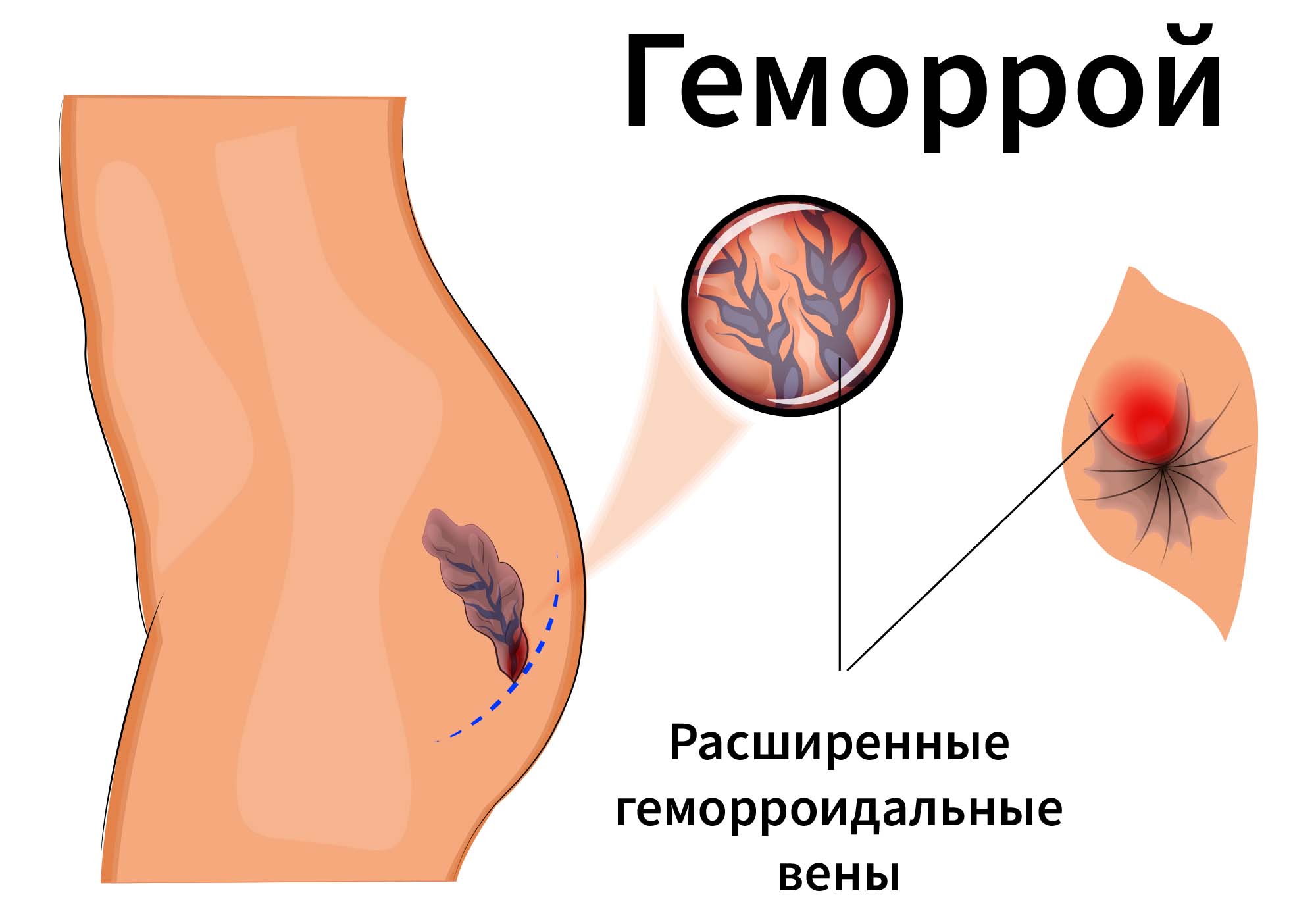 Геморрой у женщин