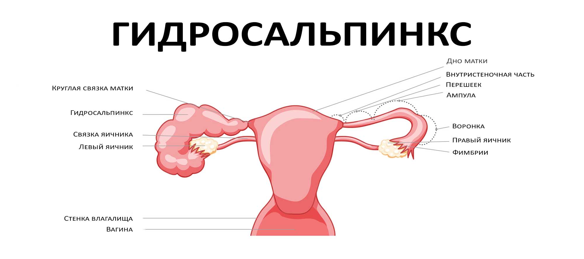 Гидросальпинкс