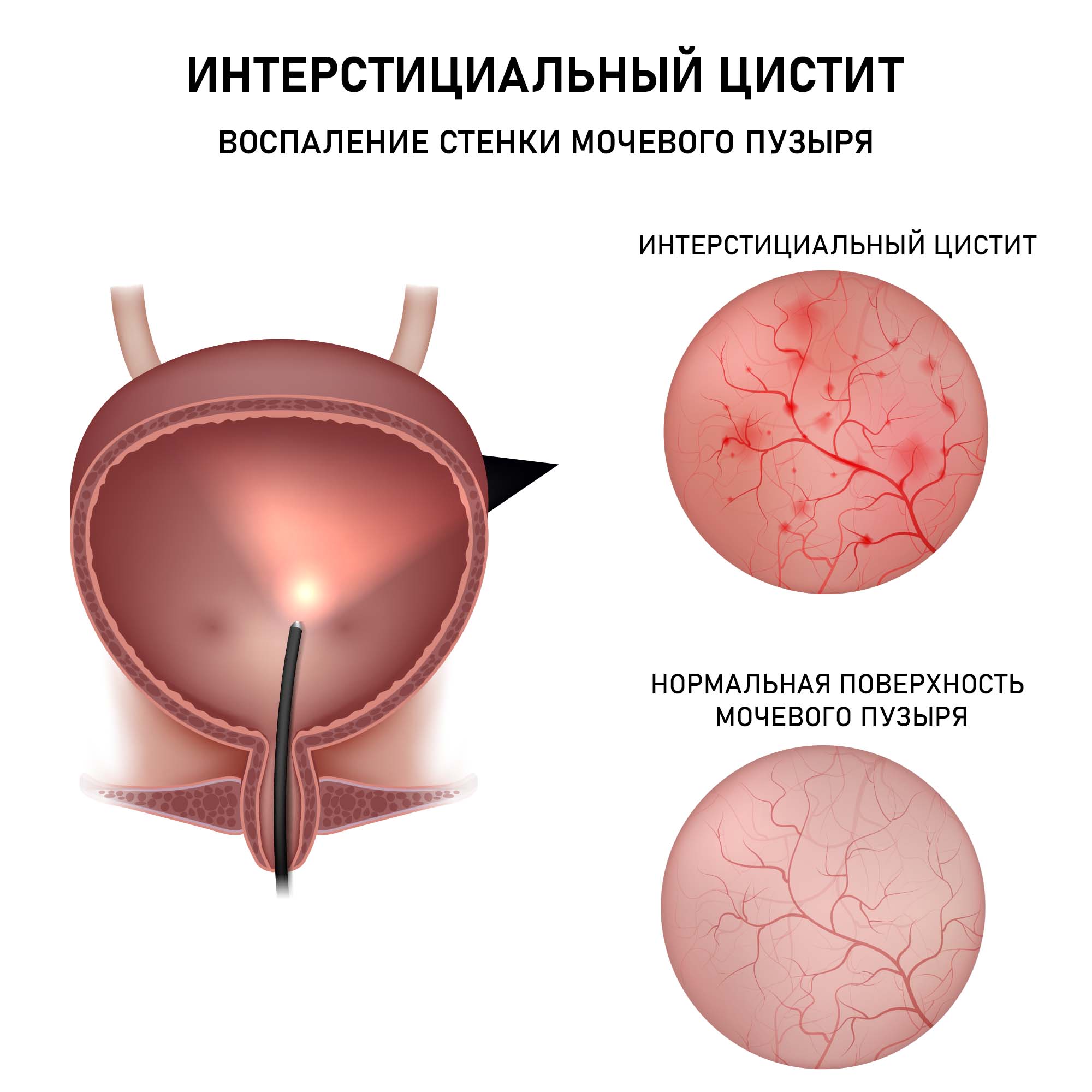 Интерстициальный цистит