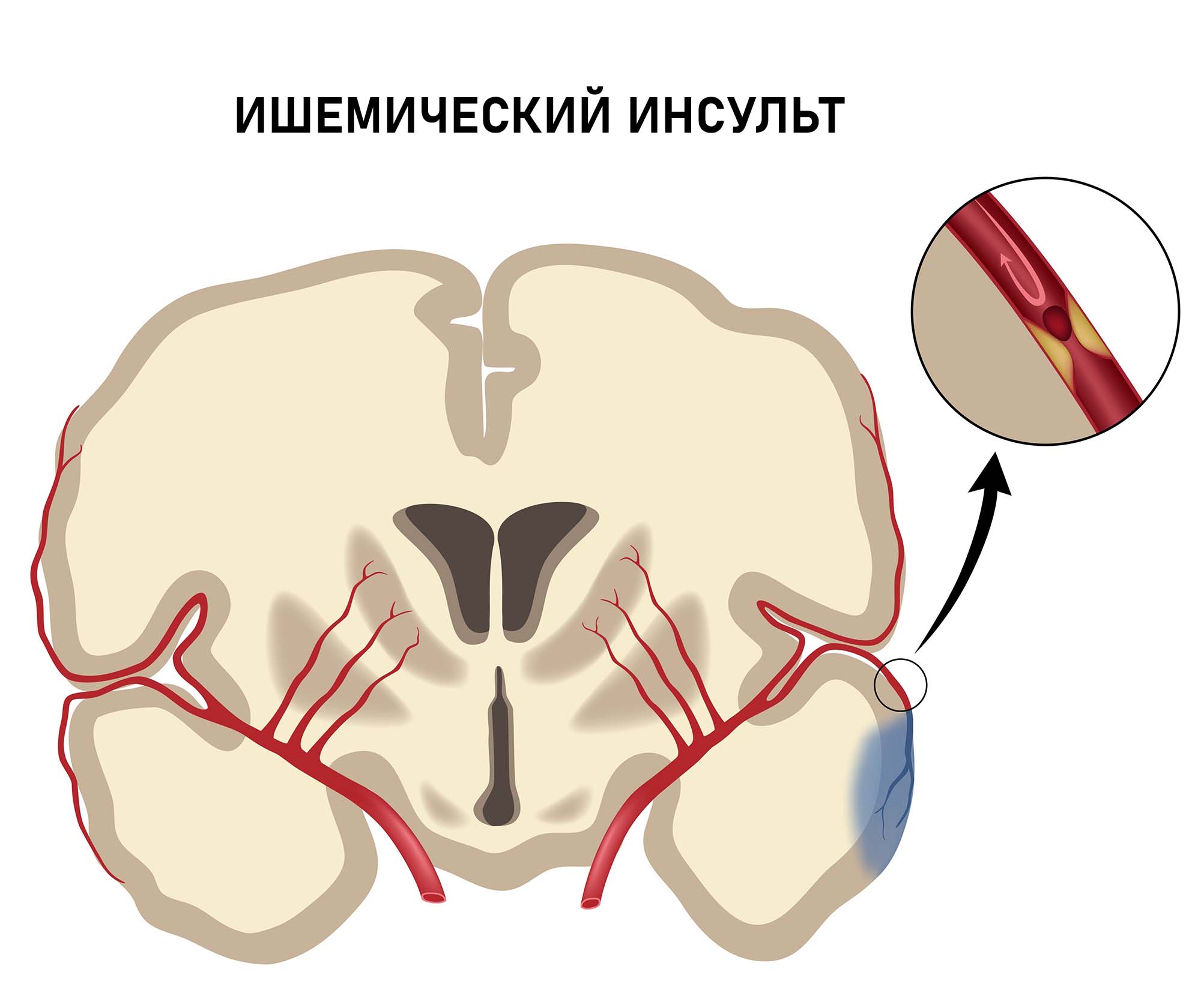 Ишемический инсульт