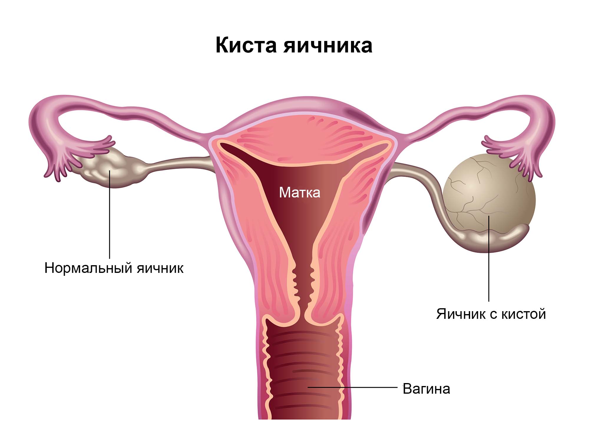 Киста яичника