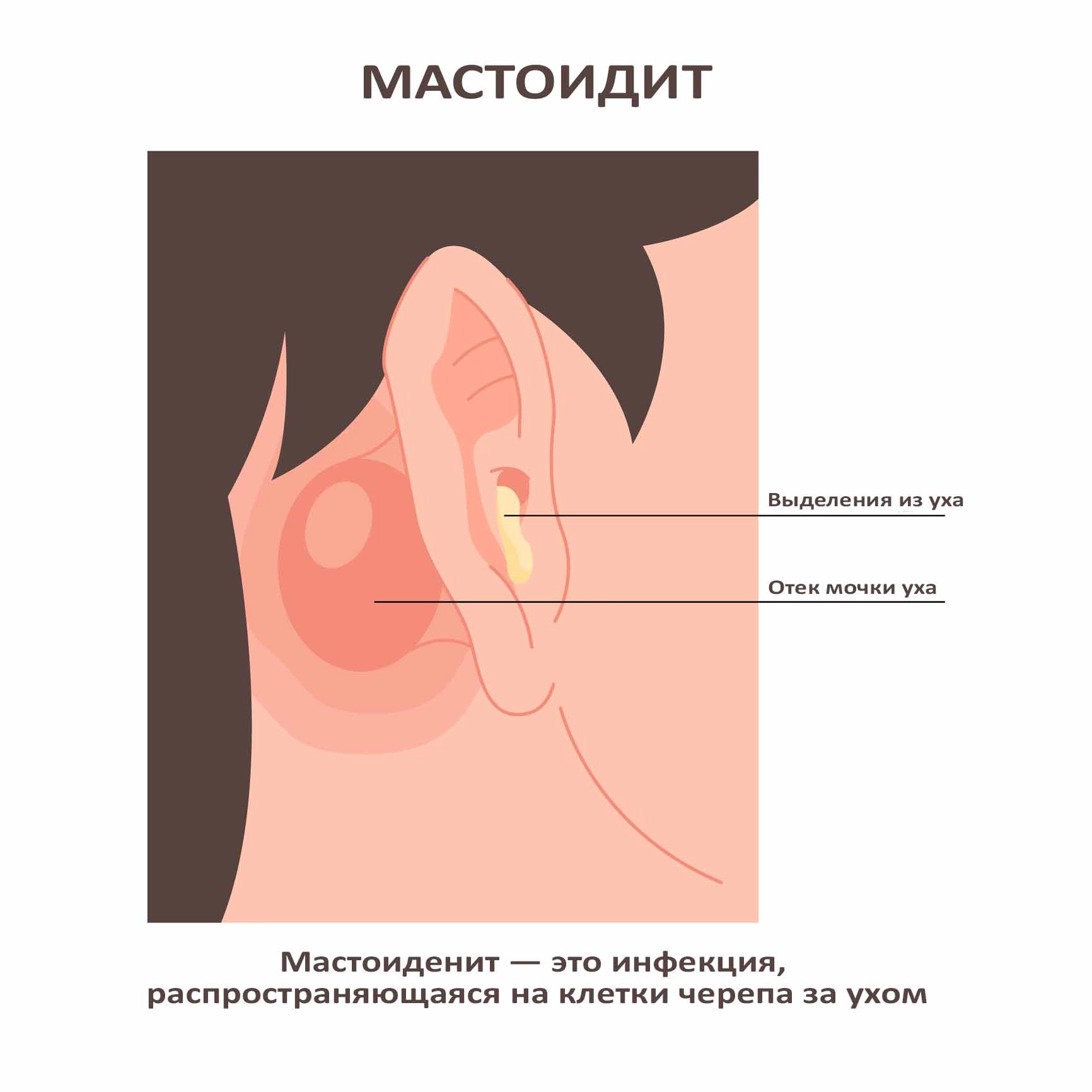Мастоидит