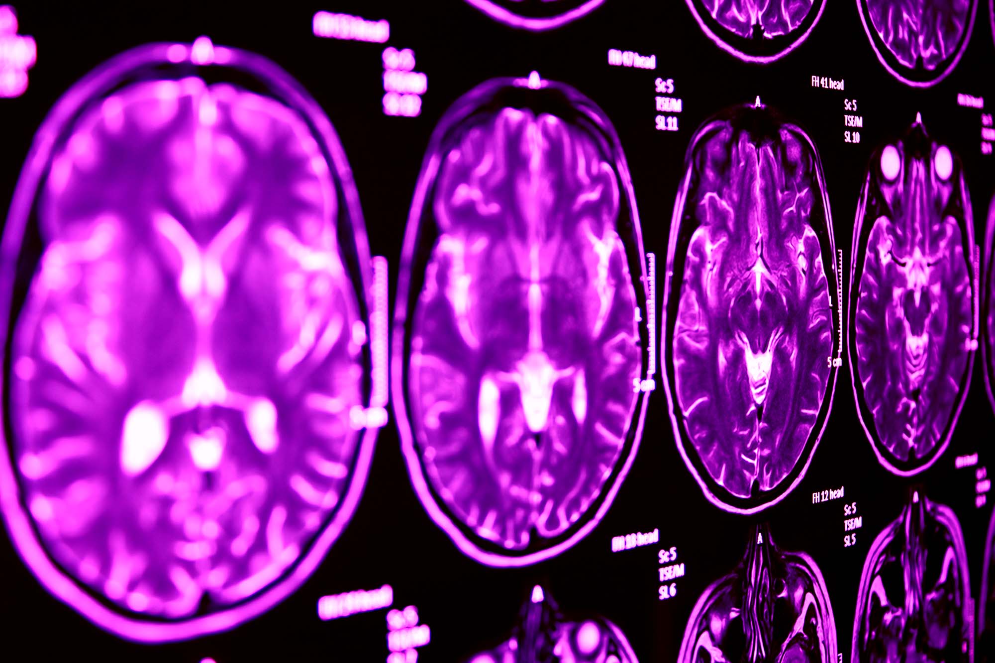 Мрт мозга собаке. При синдроме Туретта в головном мозге. Tourette Syndrome MRI. Autism on MRI. Formation of the Douglas MRI Space.