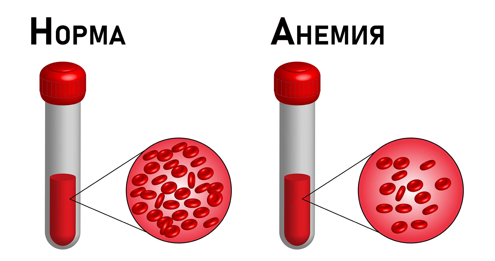 Микроцитарная анемия