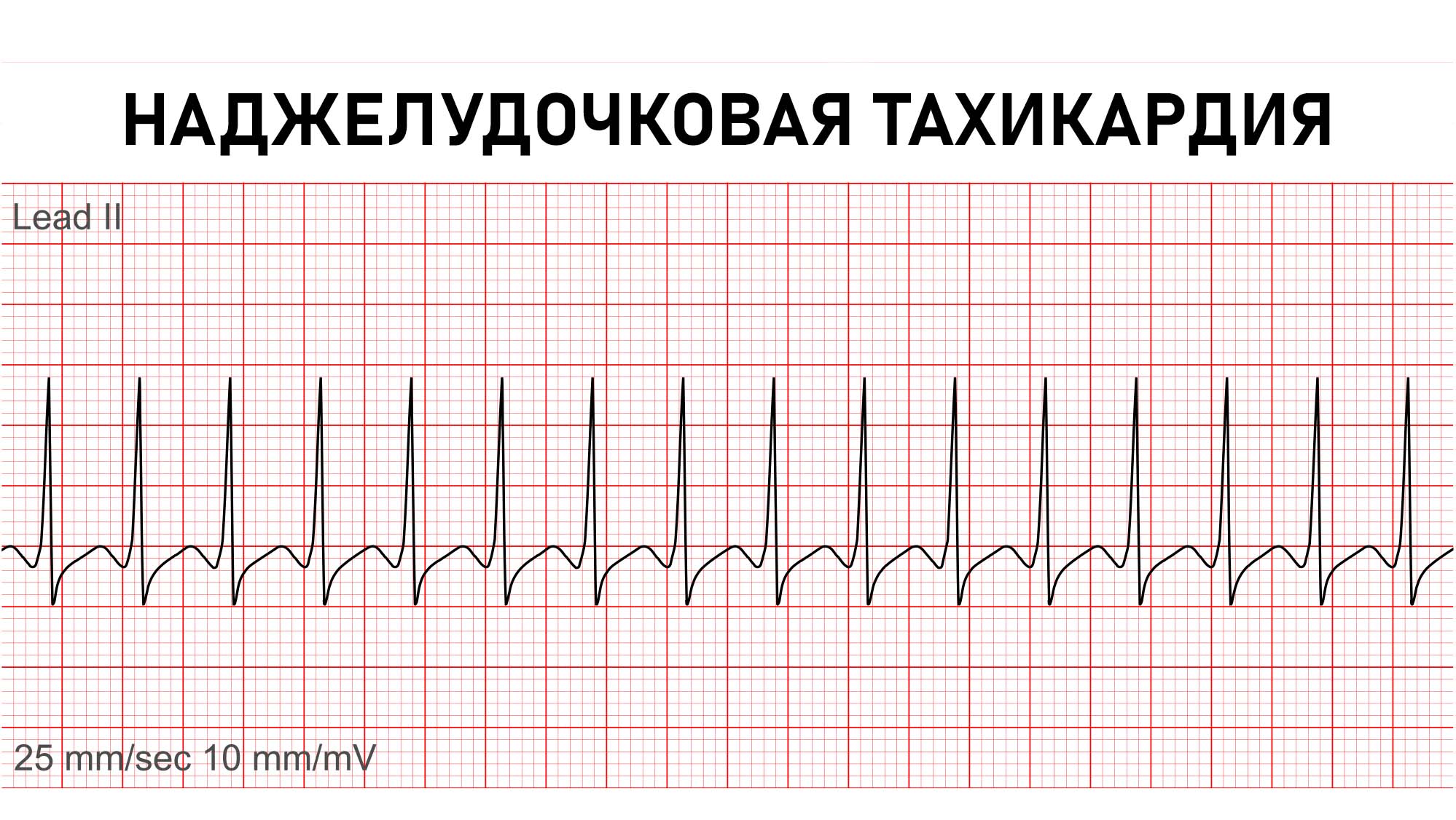 Наджелудочковая тахикардия