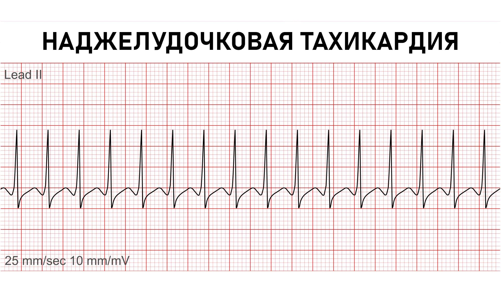 Тахикардия это симптомы и лечение у женщин. Тахикардия. Наджелудочковая тахикардия. Синусовая тахикардия на ЭКГ. Наджелудочковая тахикардия клинические рекомендации.