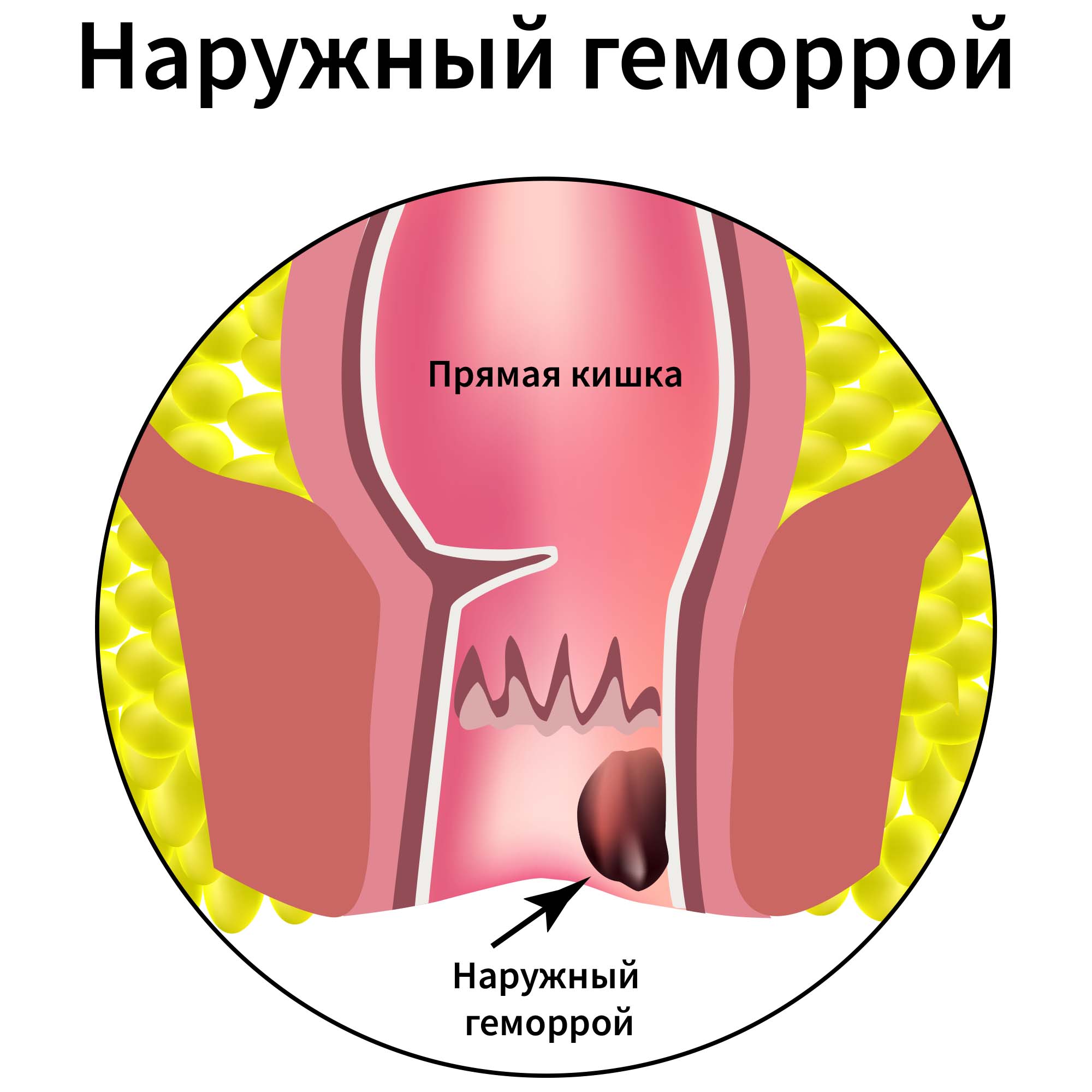 Наружный геморрой