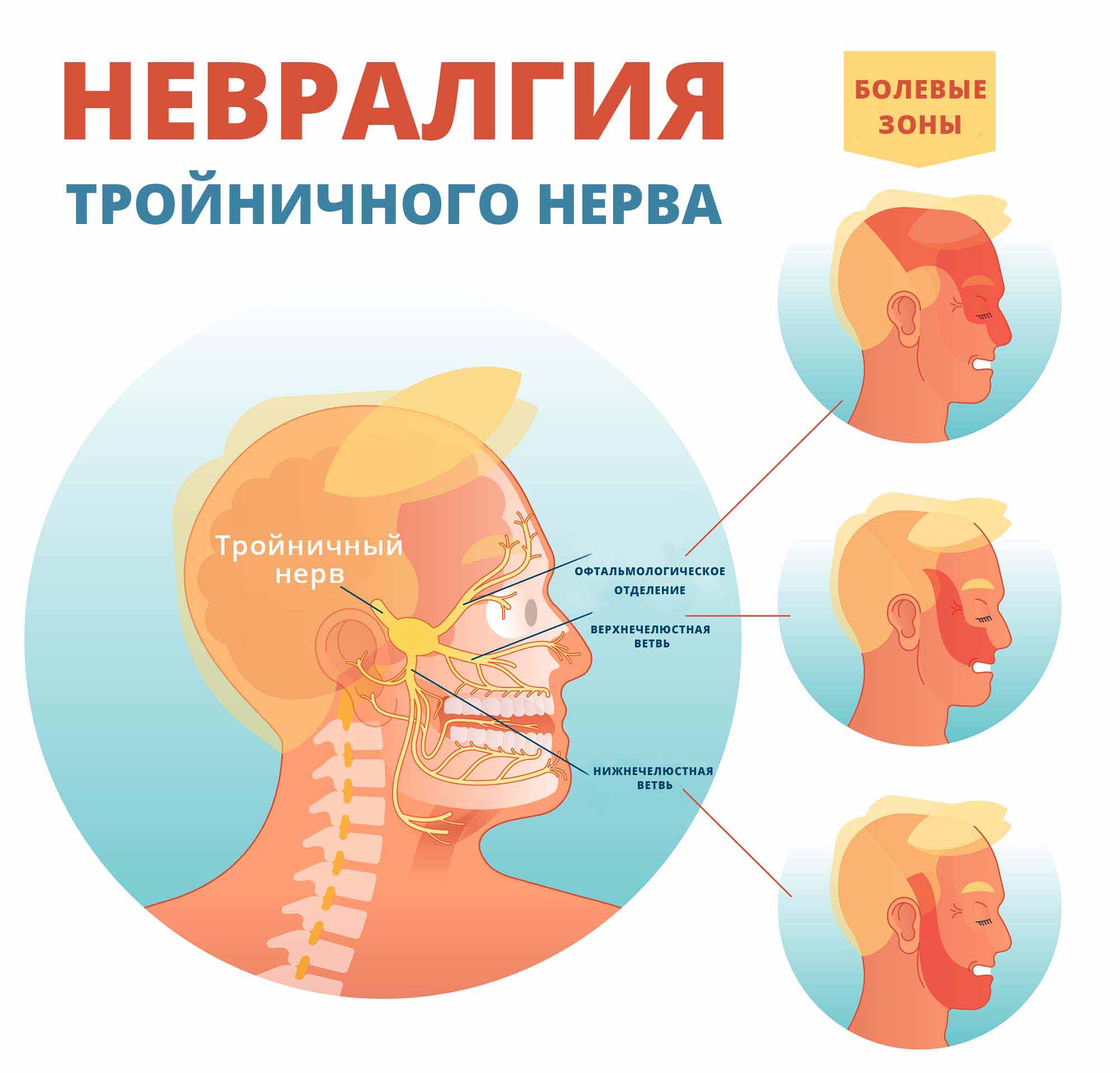 Невралгия тройничного нерва