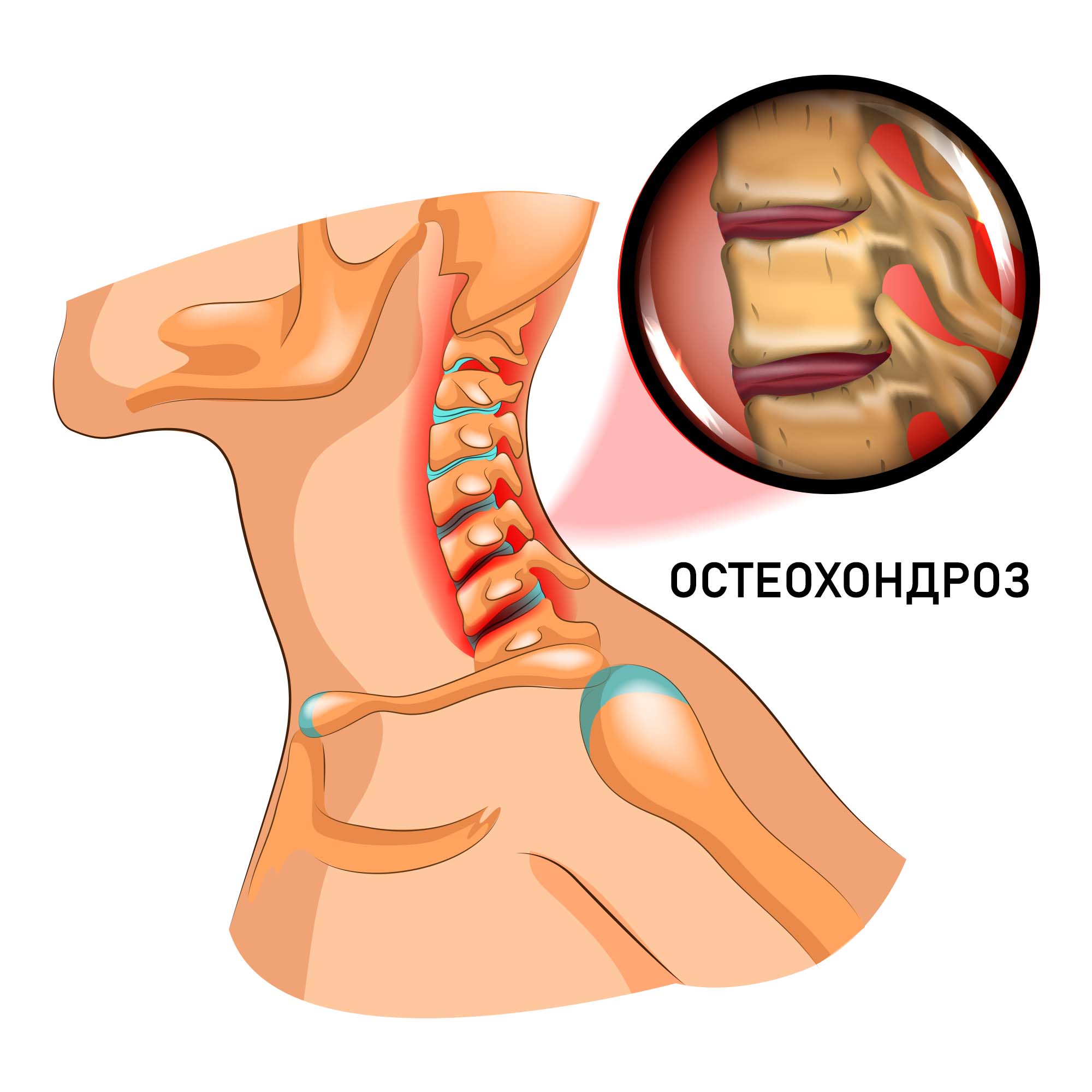 Остеохондроз шейного отдела