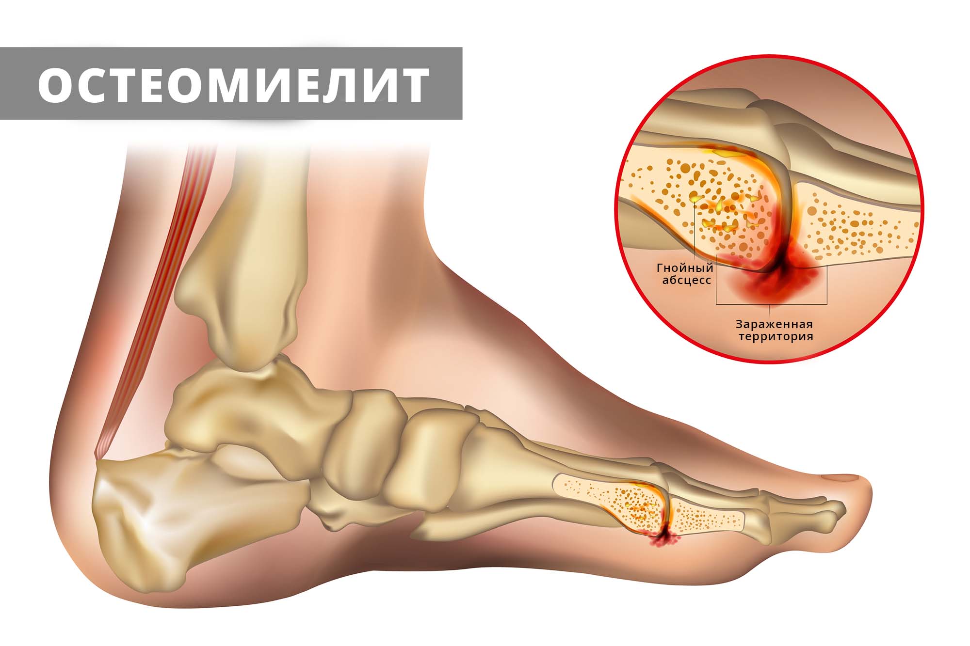 Остеомиелит