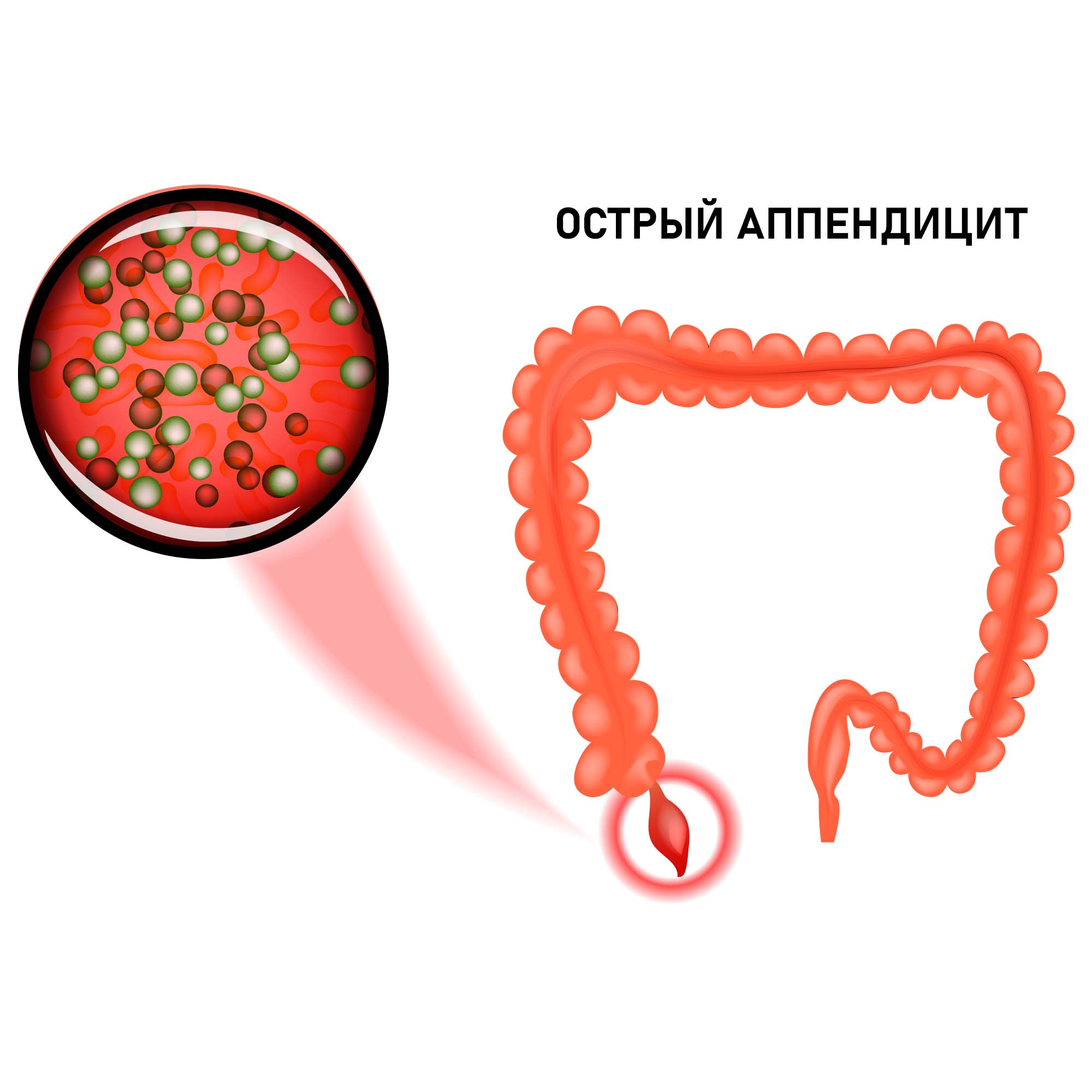 Аппендицит в 3 года. Острый флегмонозный аппендицит.