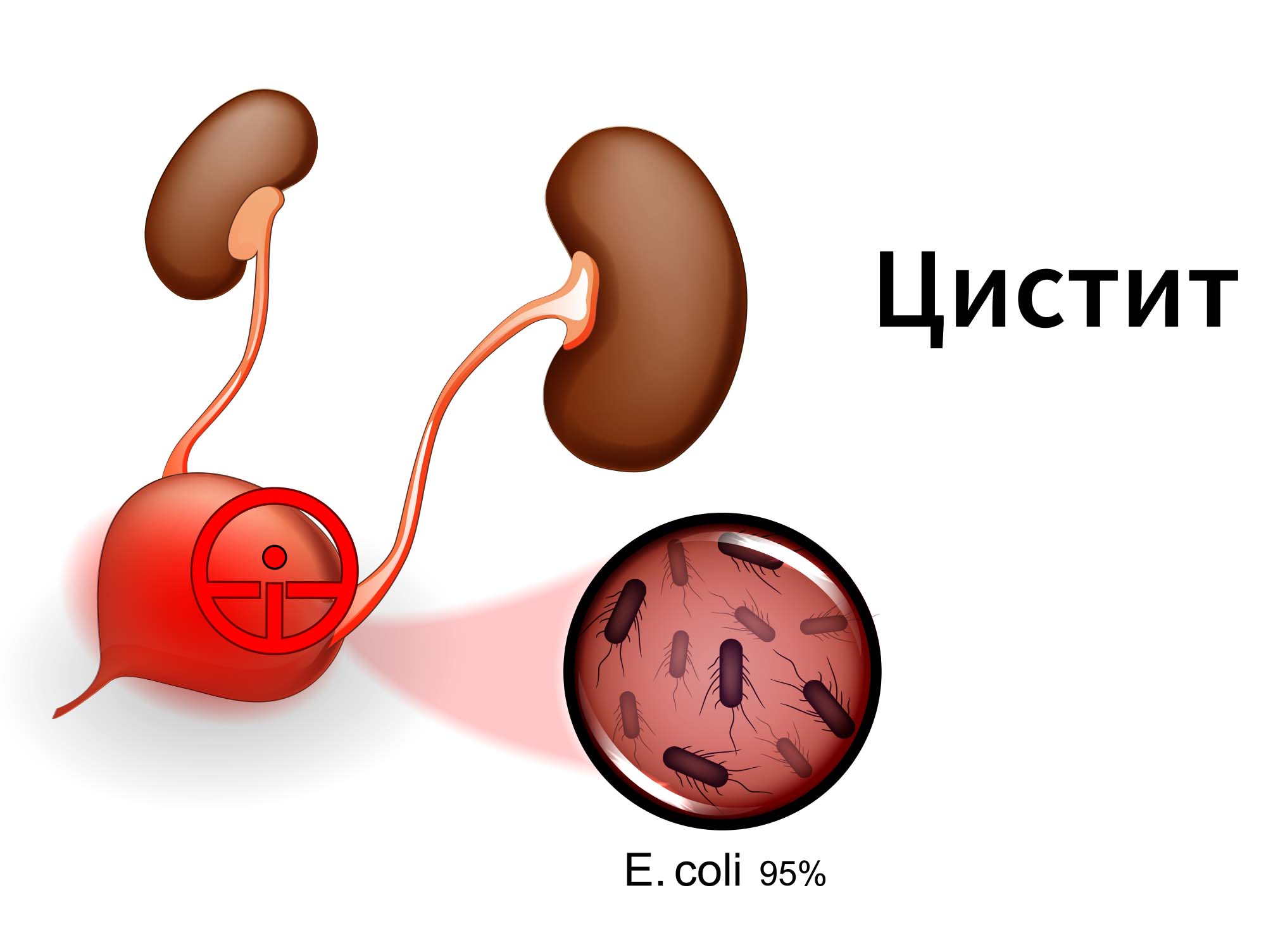 Цистит после интимной близости (посткоитальный цистит)