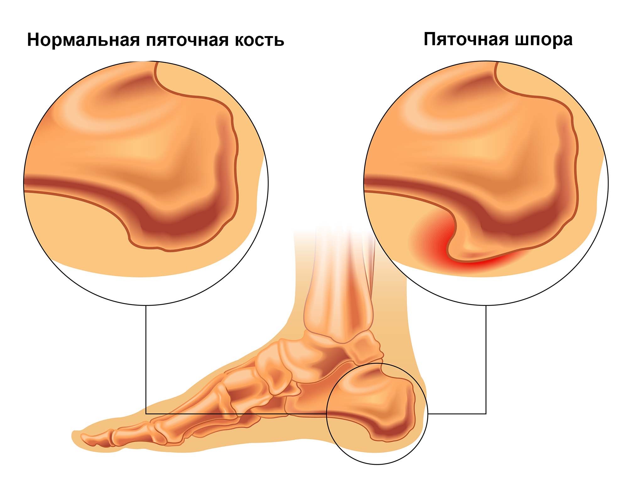 Пяточная шпора (плантарный фасциит)