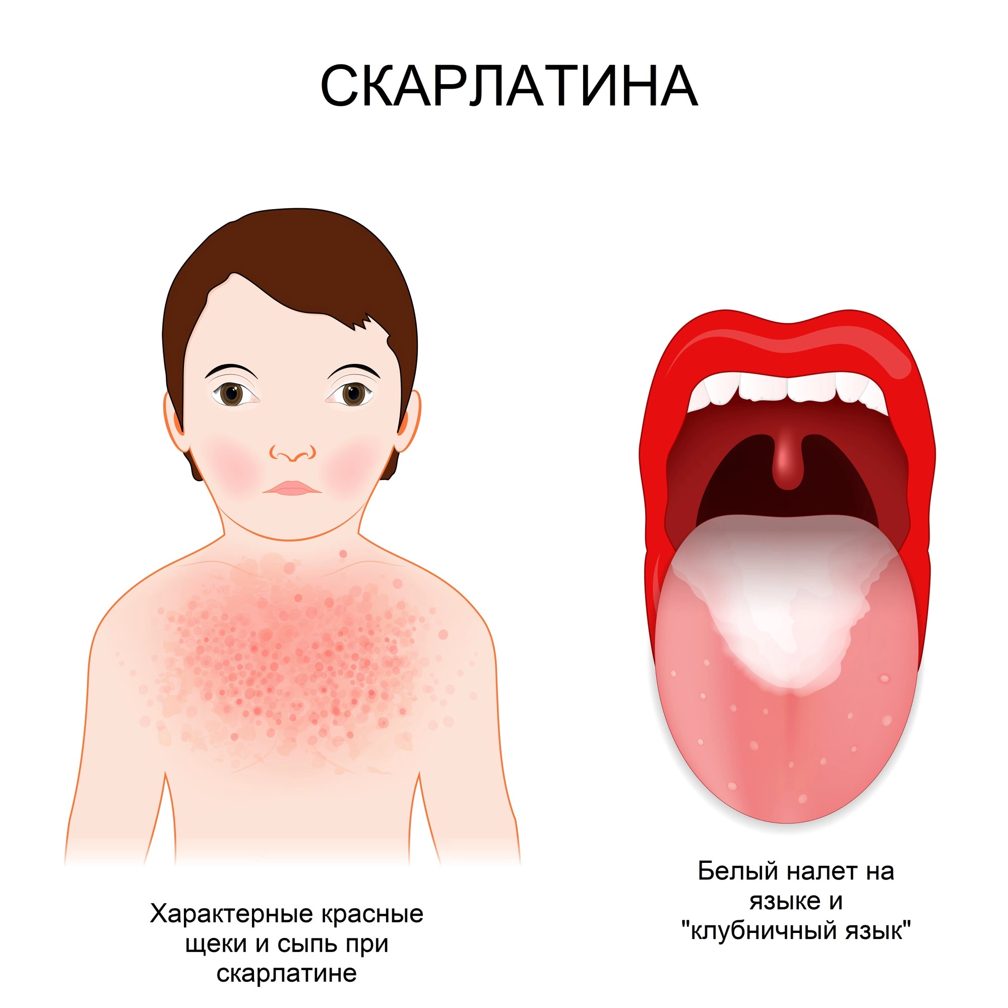 Скарлатина у взрослых: признаки, симптомы, диагностика, как передается, лечение