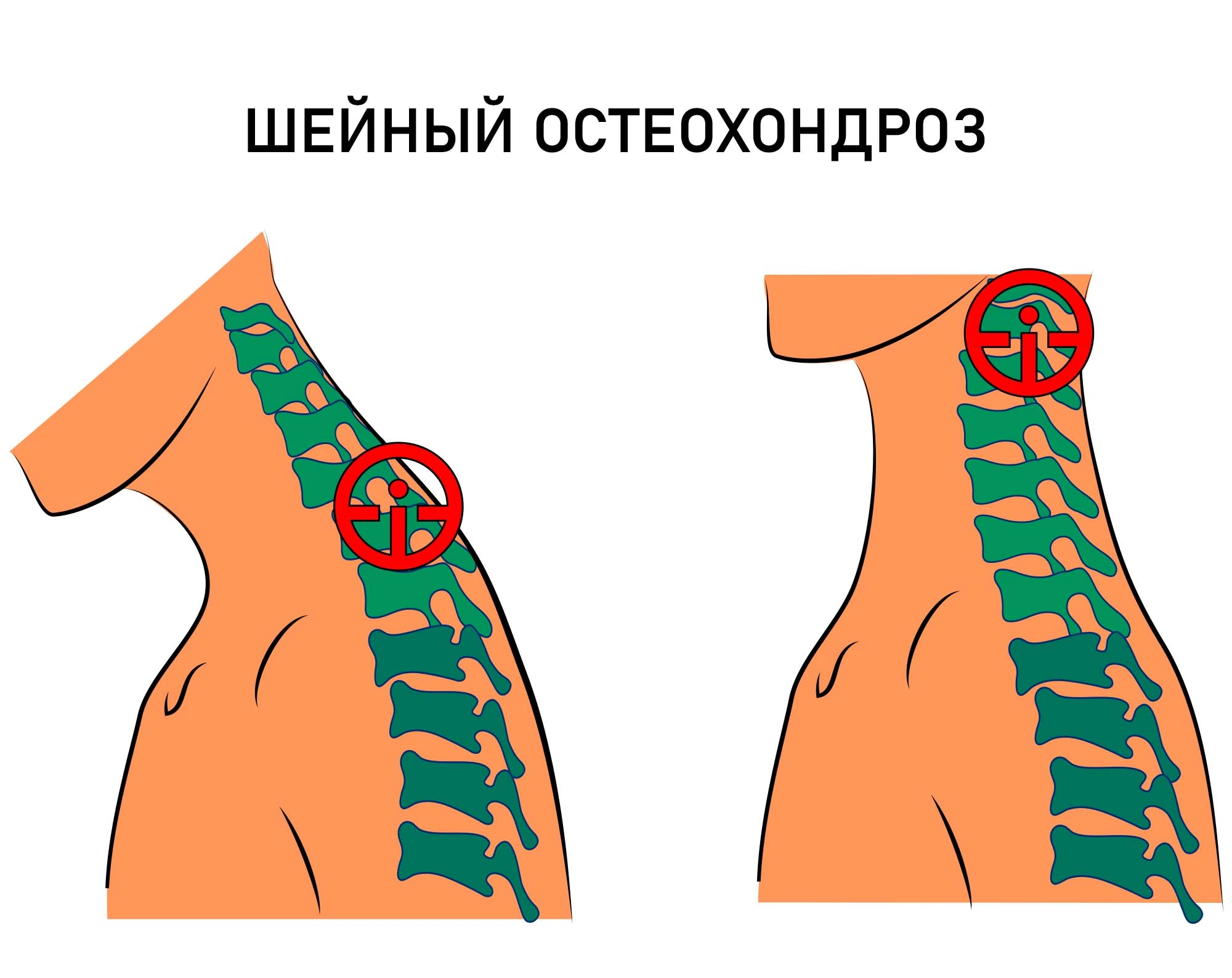 Пояснично-крестцовый остеохондроз - причины, симптомы, диагностика, лечение и профилактика