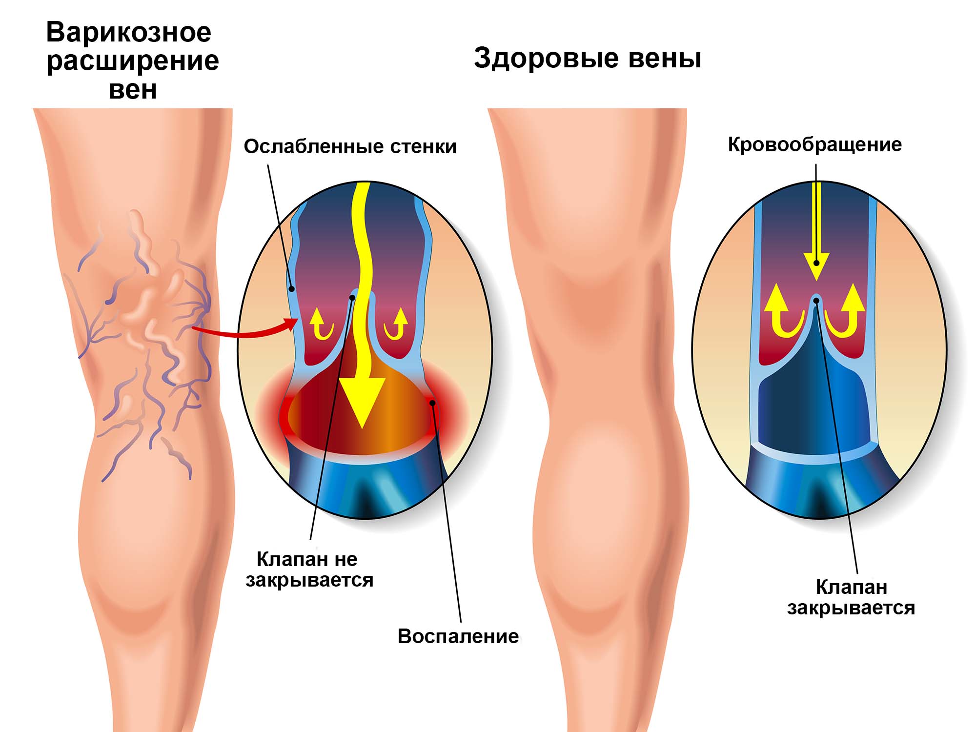 Варикоз