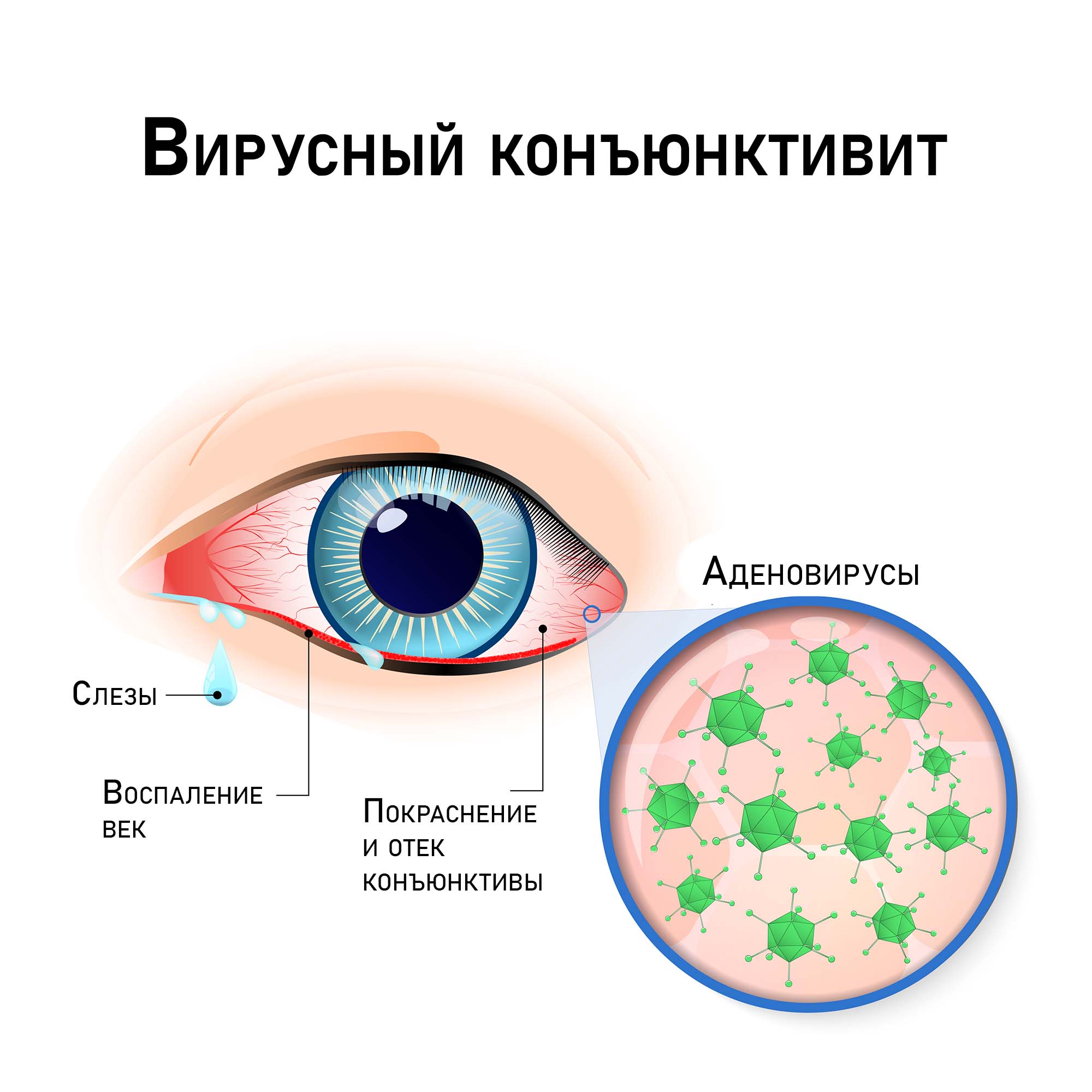 Вирусный конъюнктивит