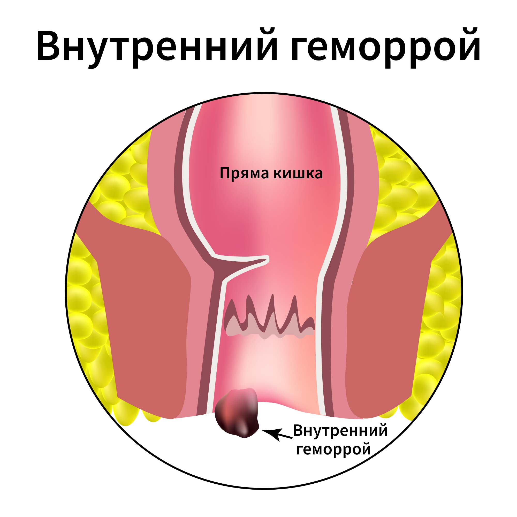 Внутренний геморрой