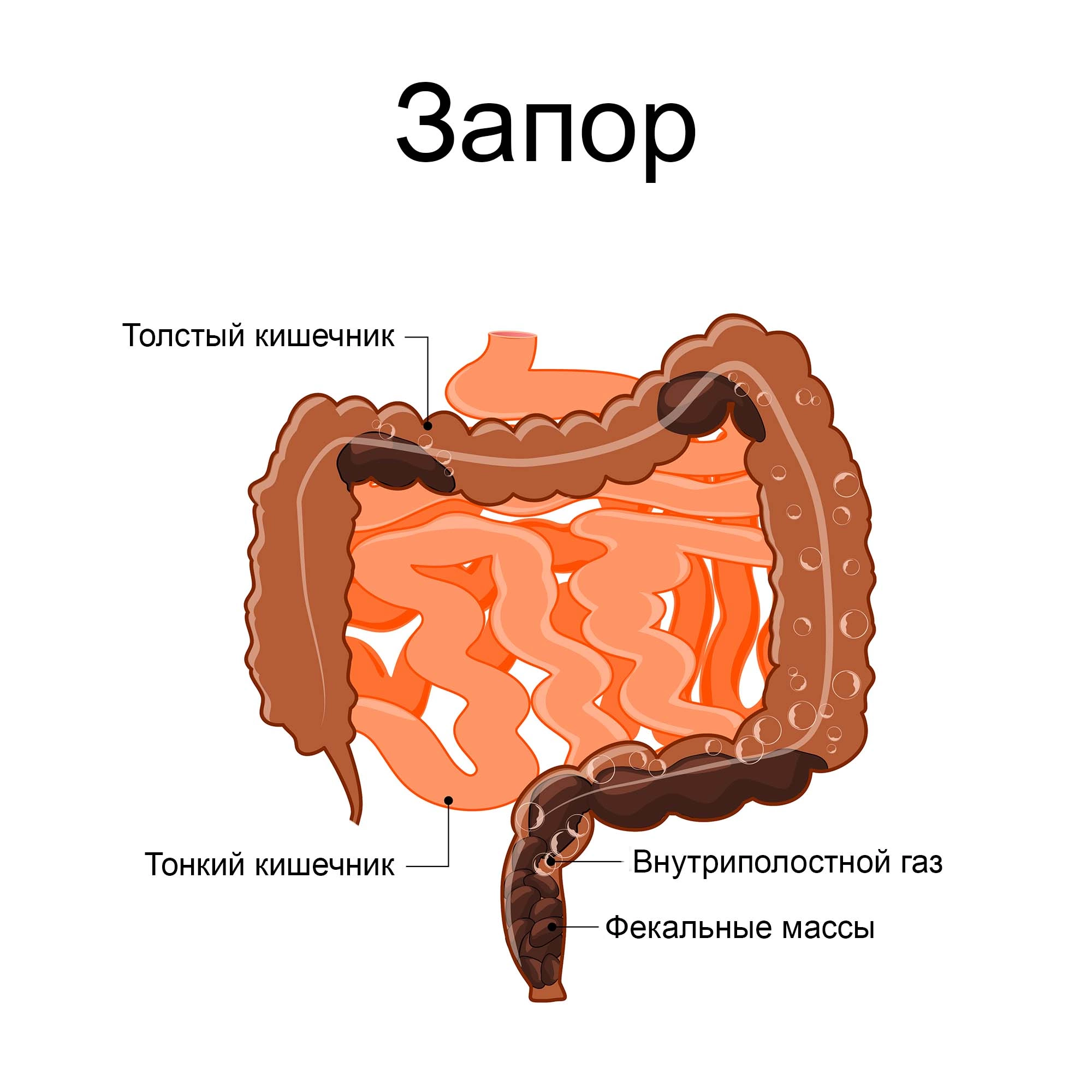 Запор: причины, симптомы, признаки, чем опасен, лечение, профилактика